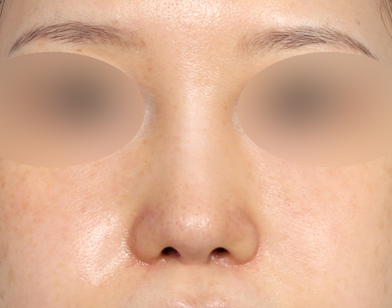 [코재개방+3d맞춤보형물4mm+실리콘제거+기증늑해제+귀연골+귀뒤진피] 후