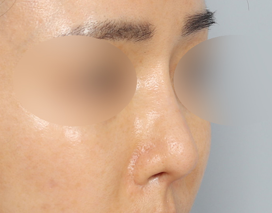 [코재수술+실리콘제거+3d맞춤보형물1.3mm] 전