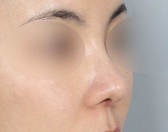 [개방형첫수술+반영구필러제거+3d맞춤보형물3.5mm+귀연골+비중격+귀뒤진피+코끝연골재배치+기능코2종(비중격,비갑개)] 후