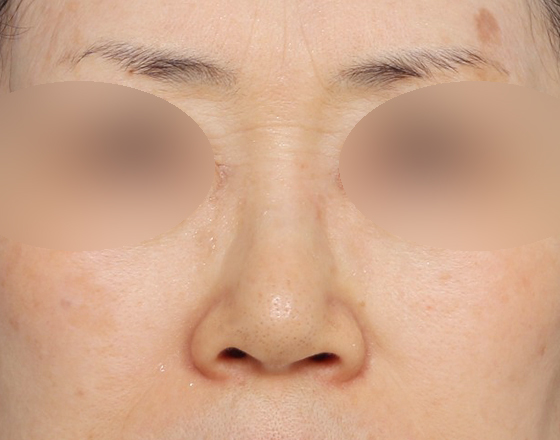 [코재개방+실리콘제거+귀연골+귀뒤진피+3d보형물3.0mm+코끝연골재배치] 전