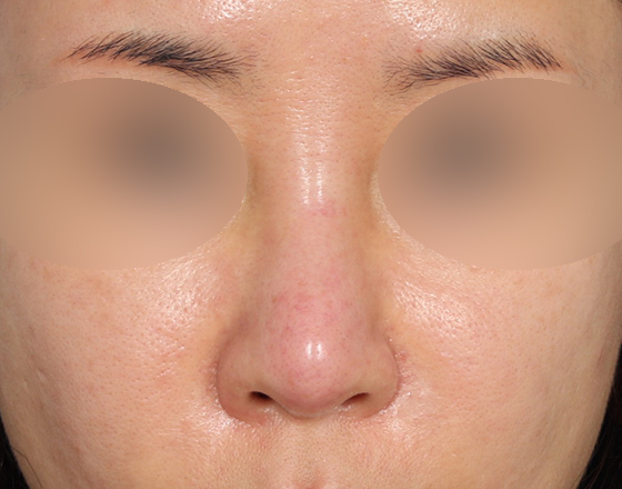 [개방형첫수술+실제거+반영구피러제거+귀연골+귀뒤진피+3d맞춤보형물2.5mm+매부리+코끝연골재배치] 전