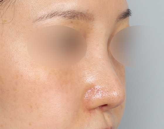 [코재개방+3d맞춤보형물4mm+실리콘제거+기증늑해제+귀연골+귀뒤진피] 후