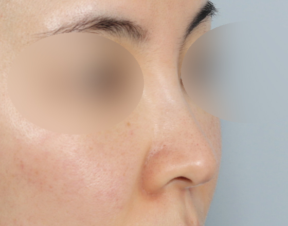 [개방형첫수술+반영구필러제거+3d맞춤보형물3.5mm+귀연골+비중격+귀뒤진피+코끝연골재배치+기능코2종(비중격,비갑개)] 전