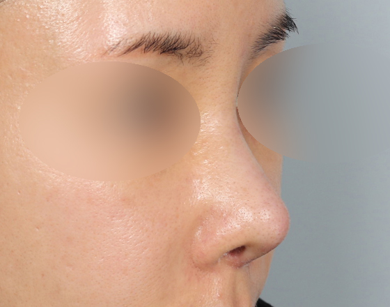 [개방형첫수술+실제거+반영구피러제거+귀연골+귀뒤진피+3d맞춤보형물2.5mm+매부리+코끝연골재배치] 후