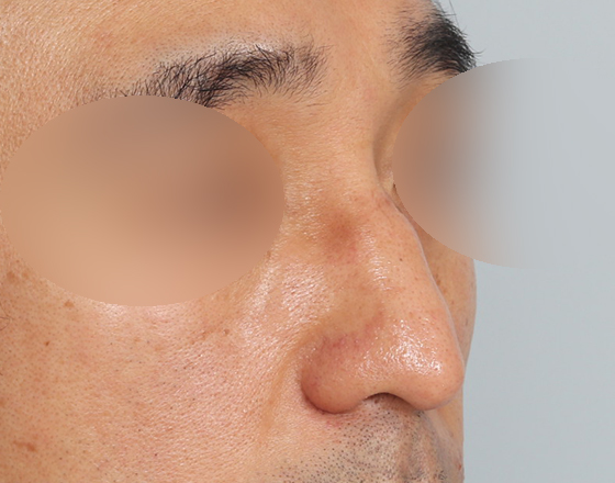 [개방형첫수술+무보형물+귀연골+비중격+귀뒤진피+흡수성콜라겐막+메부리+코끝연골재배치+기능코2종(비중격,비갑개)+절개눈매교정] 전