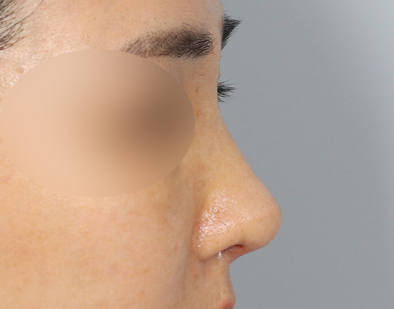 [코재수술+실리콘제거+3d맞춤보형물1.3mm] 후