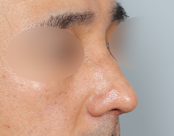 [개방형첫수술+무보형물+귀연골+비중격+귀뒤진피+흡수성콜라겐막+메부리+코끝연골재배치+기능코2종(비중격,비갑개)+절개눈매교정] 후